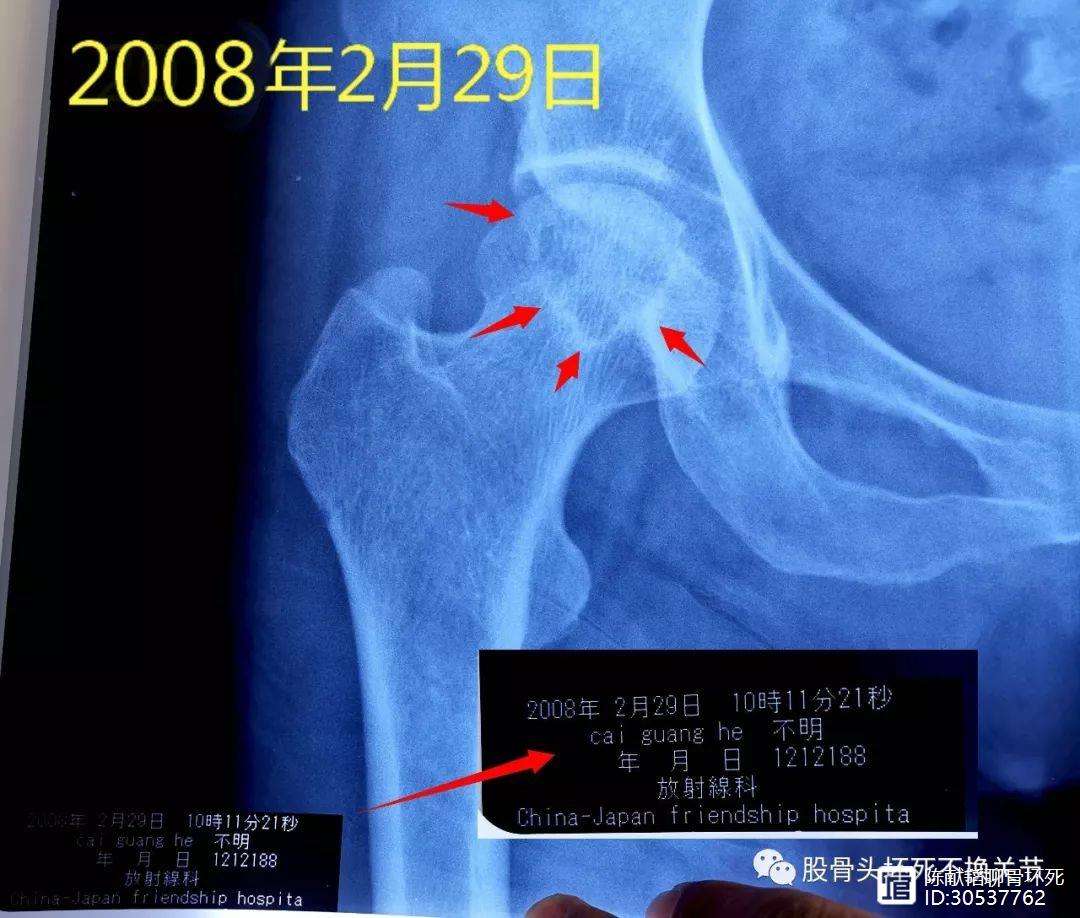 盐城人工骨头医保报销多少(人工骨头医保报销多少比例)